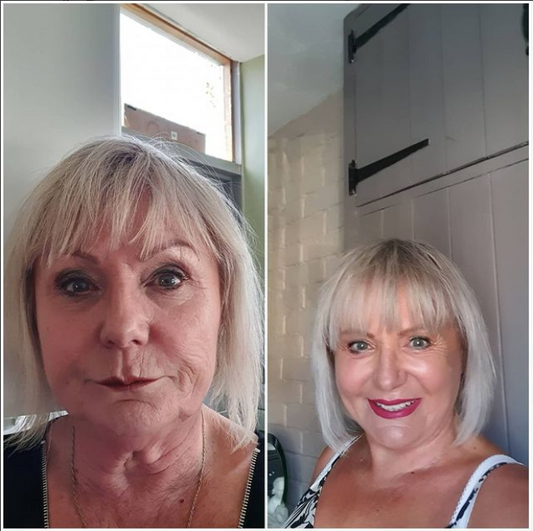 My Facelift Journey